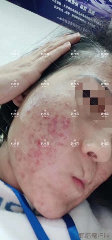 化妝品店主的變臉級祛痘反饋,粉刺痘痘全部消了