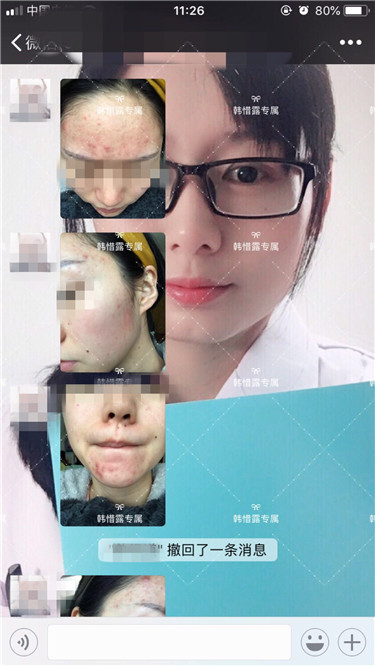 【視頻】臉上長粉刺怎樣去掉？醫院都沒搞定韓惜露幫我搞定了，超級開心！