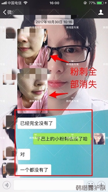 粉刺密密麻麻,試過(guò)很多方法無(wú)果后找韓惜露老師輕松去掉粉刺!