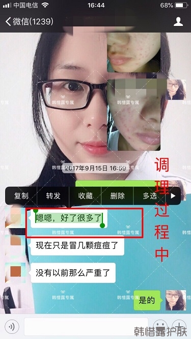 額頭長痘臉頰長痘痘粉刺，這樣調理幫你恢復嫩白肌膚！