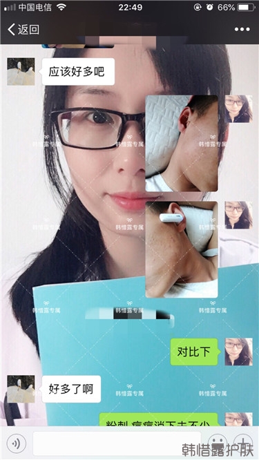 粉刺消了，皮膚光滑了，變帥氣不少呦！