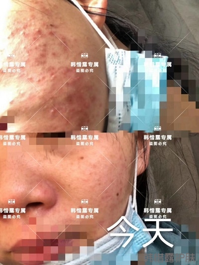 臉上長(zhǎng)閉口粉刺怎么去除,粉刺消下去了，皮膚變好了