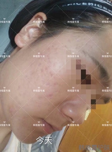 好好使用，膿包痘痘,小粉刺全消了,重點修復痘印痘坑印了