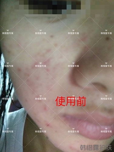 額頭長痘臉頰長痘痘粉刺，這樣調理幫你恢復嫩白肌膚！