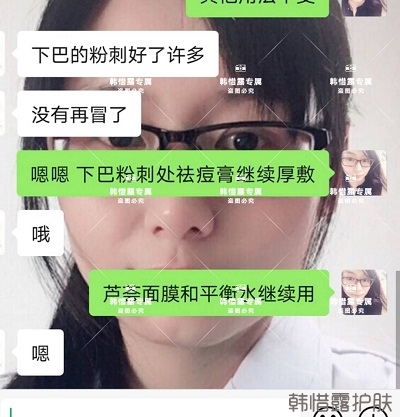 閉口粉刺怎么去除，下巴粉刺好了許多，粉刺沒有再長了