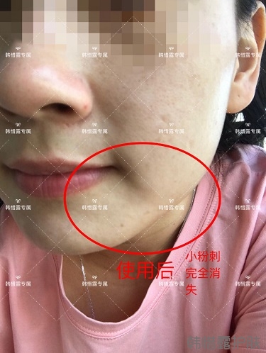 粉刺密密麻麻,試過(guò)很多方法無(wú)果后找韓惜露老師輕松去掉粉刺!