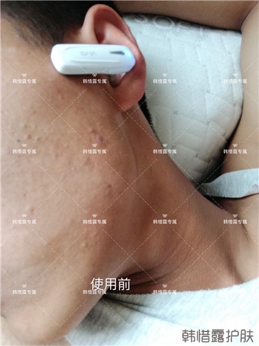 粉刺消了，皮膚光滑了，變帥氣不少呦！