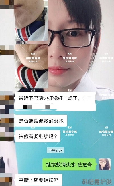 怎么消除臉上的痘痘,發(fā)硬膿包消下去了