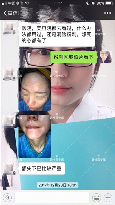 【視頻】臉上長粉刺怎樣去掉？醫院都沒搞定韓惜露幫我搞定了，超級開心！