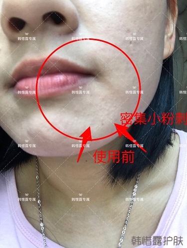 粉刺密密麻麻,試過(guò)很多方法無(wú)果后找韓惜露老師輕松去掉粉刺!