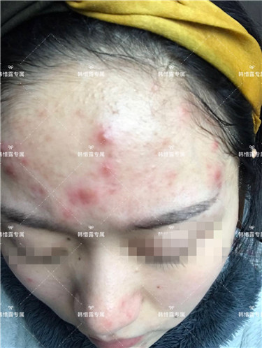 【視頻】臉上長粉刺怎樣去掉？醫院都沒搞定韓惜露幫我搞定了，超級開心！