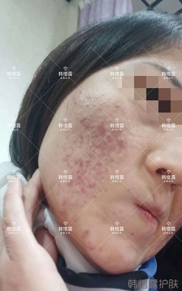 化妝品店主的變臉級祛痘反饋,粉刺痘痘全部消了