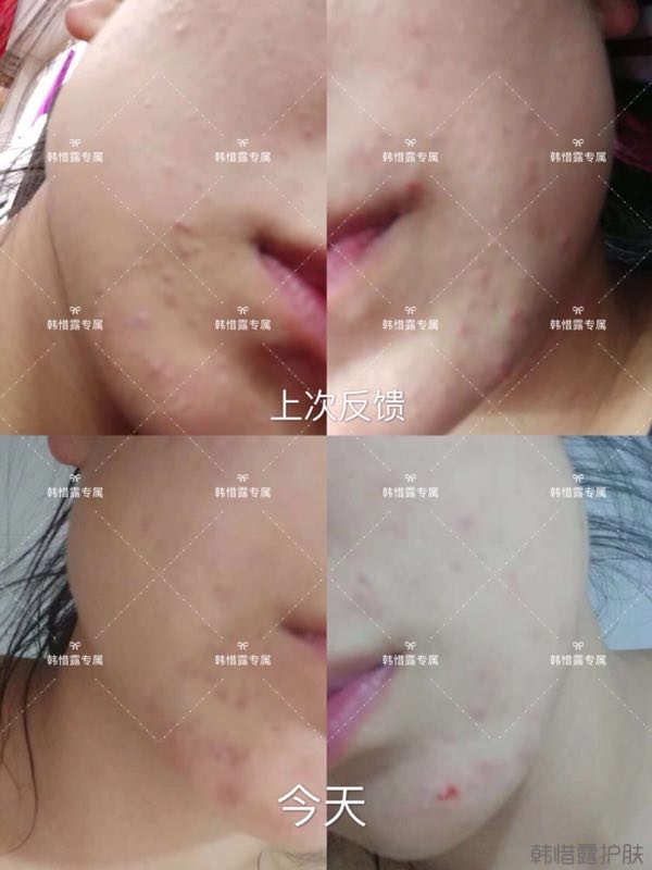 粉刺多怎么辦？按照要求配套耐心使用，粉刺消下去不少！