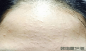 如何去除額頭的粉刺?