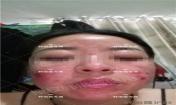 【祛痘視頻反饋】激素臉長(zhǎng)痘20多年,大膿包,發(fā)癢,完全恢復(fù)!